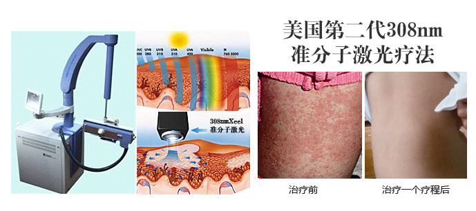 康复治疗激光怎么收费3D净血细胞祛癣疗法八大康复项目_https://www.jmylbn.com_新闻资讯_第2张