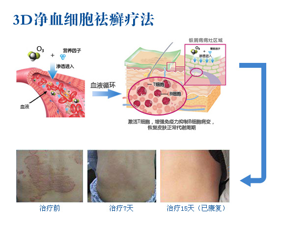 康复治疗激光怎么收费3D净血细胞祛癣疗法八大康复项目_https://www.jmylbn.com_新闻资讯_第1张